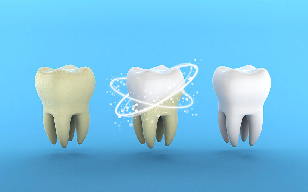 Het belang van tandsteen verwijderen en tanden polijsten