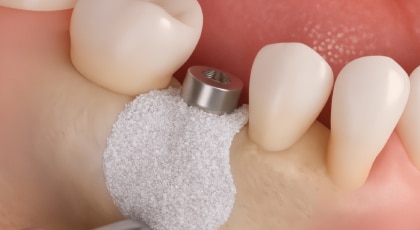 Botopbouw voor implantaten